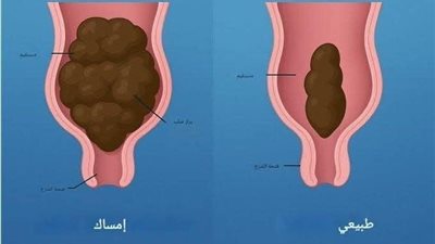 الطريقة الصحيحة والفعالة لتطهير القولون خطوة بخطوة